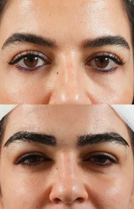 Eyebrow Hair Transplant before and after
