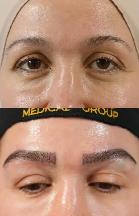 Eyebrow Hair Transplant before and after