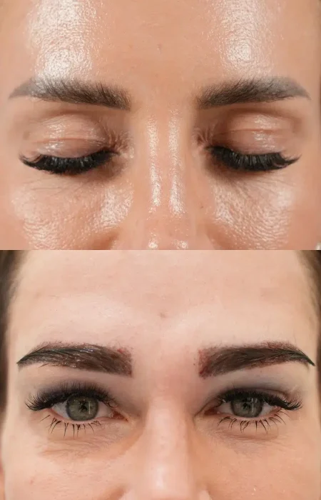 Eyebrow Hair Transplant before and after